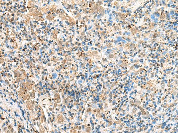 Immunohistochemistry of paraffin-embedded Human cervical cancer tissue  using SNAPC1 Polyclonal Antibody at dilution of 1:60(?200)