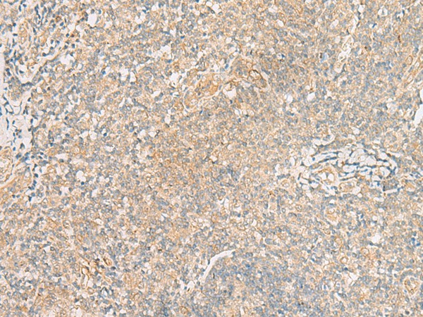 Immunohistochemistry of paraffin-embedded Human tonsil tissue  using TRAF6 Polyclonal Antibody at dilution of 1:30(?200)