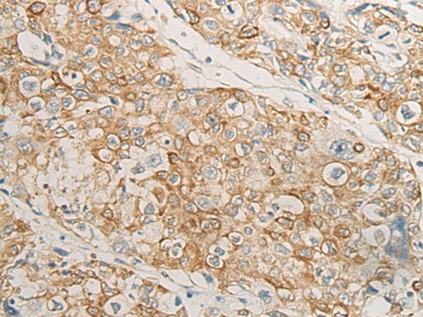 Immunohistochemistry of paraffin-embedded Human prost at e cancer tissue  using HLA-DMB Polyclonal Antibody at dilution of 1:40(?200)