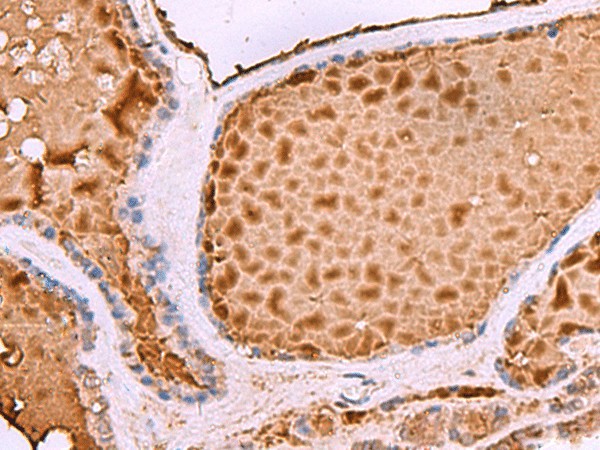 Immunohistochemistry of paraffin-embedded Human thyroid cancer tissue  using ASTE1 Polyclonal Antibody at dilution of 1:50(?200)