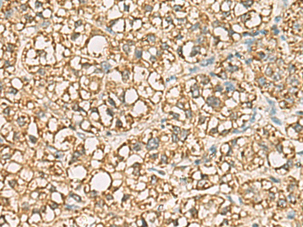 Immunohistochemistry of paraffin-embedded Human liver cancer tissue  using VTA1 Polyclonal Antibody at dilution of 1:85(?200)