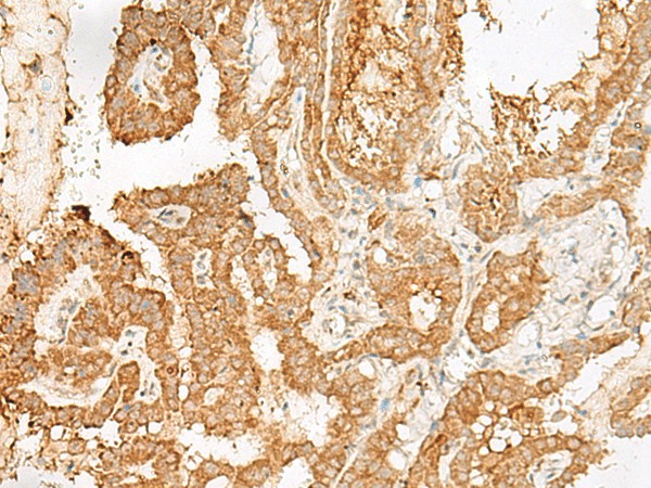 Immunohistochemistry of paraffin-embedded Human thyroid cancer tissue  using ADGRF1 Polyclonal Antibody at dilution of 1:25(?200)