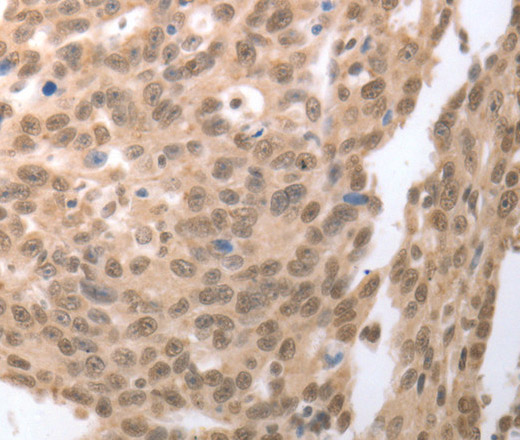 Immunohistochemistry of paraffin-embedded Human ovarian cancer tissue using RAD52 Polyclonal Antibody at dilution 1:50