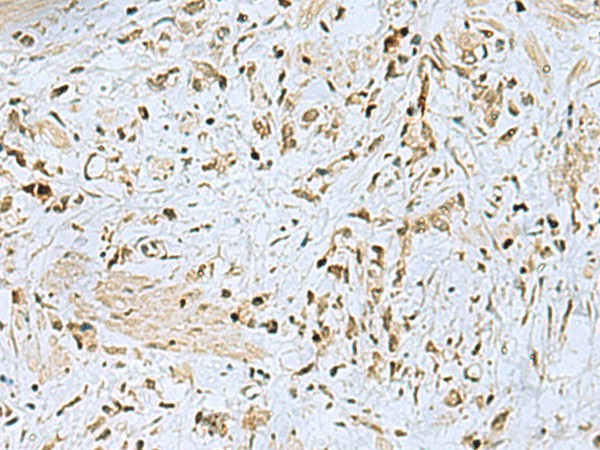 Immunohistochemistry of paraffin-embedded Human gastric cancer tissue  using HOXC9 Polyclonal Antibody at dilution of 1:40(?200)