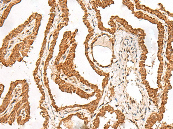 Immunohistochemistry of paraffin-embedded Human thyroid cancer tissue  using FER Polyclonal Antibody at dilution of 1:90(?200)