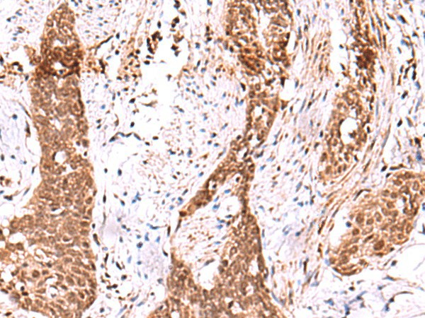 Immunohistochemistry of paraffin-embedded Human esophagus cancer tissue  using AK9 Polyclonal Antibody at dilution of 1:85(?200)