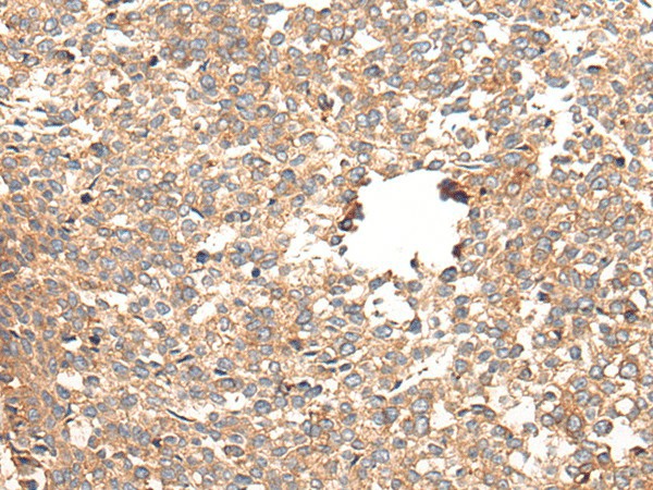 Immunohistochemistry of paraffin-embedded Human esophagus cancer tissue  using CACNG5 Polyclonal Antibody at dilution of 1:50(?200)