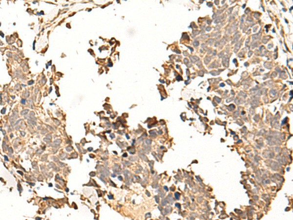 Immunohistochemistry of paraffin-embedded Human lung cancer tissue  using SOX3 Polyclonal Antibody at dilution of 1:50(?200)