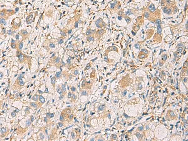 Immunohistochemistry of paraffin-embedded Human liver cancer tissue  using GNAZ Polyclonal Antibody at dilution of 1:70(?200)