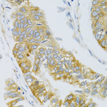 Immunohistochemistry of paraffin-embedded human gastric carcinoma using MBL2 Polyclonal antibody at dilution of 1:100 (40x lens).Perform microwave antigen retrieval with 10 mM PBS buffer pH 7.2 before commencing with IHC staining protocol