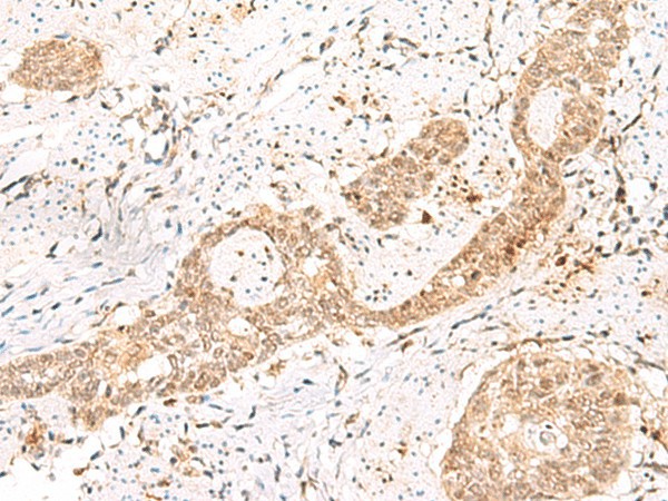 Immunohistochemistry of paraffin-embedded Human esophagus cancer tissue  using PRKAG2 Polyclonal Antibody at dilution of 1:55(?200)