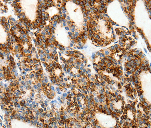 Immunohistochemistry of paraffin-embedded Human thyroid cancer tissue using SSTR1 Polyclonal Antibody at dilution 1:50