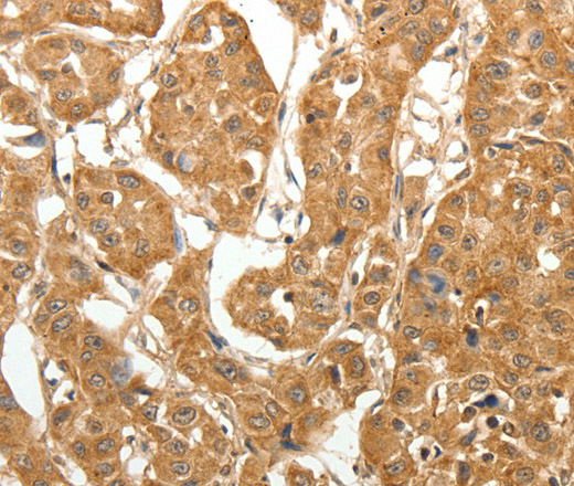 Immunohistochemistry of paraffin-embedded Human lung cancer tissue using MAP1B Polyclonal Antibody at dilution 1:60
