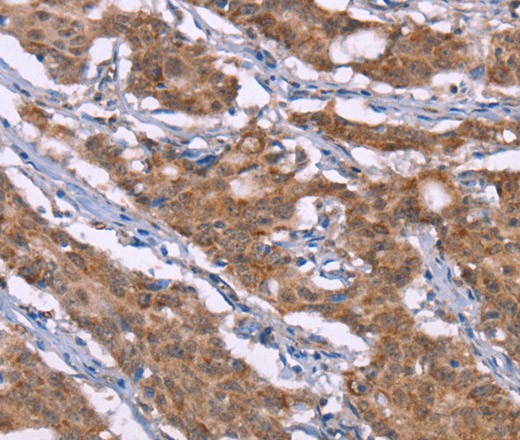 Immunohistochemistry of paraffin-embedded Human gasrtic cancer tissue using Histamine H3 Receptor Polyclonal Antibody at dilution 1:40