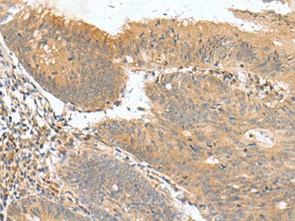 Immunohistochemistry of paraffin-embedded Human colorectal cancer tissue  using HHIPL2 Polyclonal Antibody at dilution of 1:50(?200)