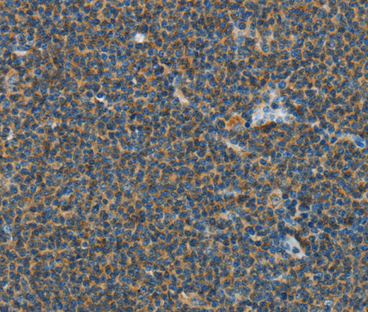 Immunohistochemistry of paraffin-embedded Human lymphoma tissue using PITX3 Polyclonal Antibody at dilution 1:40