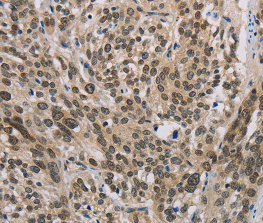 Immunohistochemistry of paraffin-embedded Human esophagus cancer using IRF9 Polyclonal Antibody at dilution of 1:50