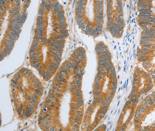 Immunohistochemistry of paraffin-embedded Human colon cancer tissue using RHEB Polyclonal Antibody at dilution 1:30