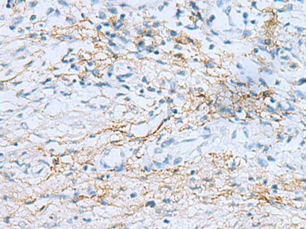 Immunohistochemistry of paraffin-embedded Human prost ate cancer tissue  using EMILIN1 Polyclonal Antibody at dilution of 1:55(?200)