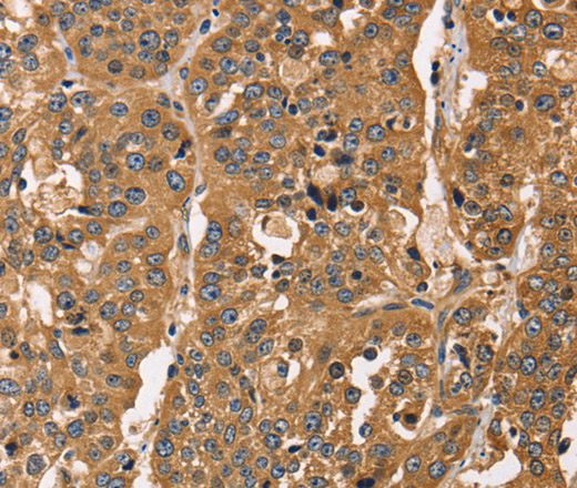 Immunohistochemistry of paraffin-embedded Human esophagus cancer tissue using CAPZA3 Polyclonal Antibody at dilution 1:40