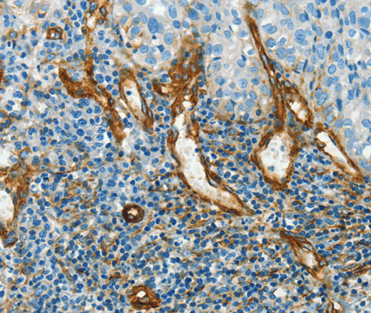 Immunohistochemistry of paraffin-embedded Human cervical cancer using CAV1 Polyclonal Antibody at dilution of 1:40