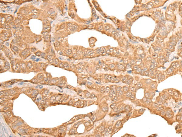 Immunohistochemistry of paraffin-embedded Human thyroid cancer tissue  using CUTA Polyclonal Antibody at dilution of 1:45(?200)