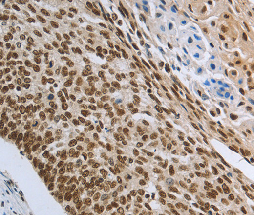 Immunohistochemistry of paraffin-embedded Human cervical cancer tissue using PRMT3 Polyclonal Antibody at dilution 1:30