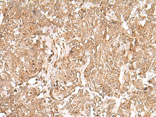 Immunohistochemistry of paraffin-embedded Human lung cancer tissue  using GMPPB Polyclonal Antibody at dilution of 1:50(?200)