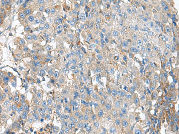 Immunohistochemistry of paraffin-embedded Human liver cancer tissue  using KIAA0556 Polyclonal Antibody at dilution of 1:90(?200)