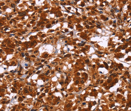 Immunohistochemistry of paraffin-embedded Human thyroid cancer tissue using HIPK1 Polyclonal Antibody at dilution 1:30