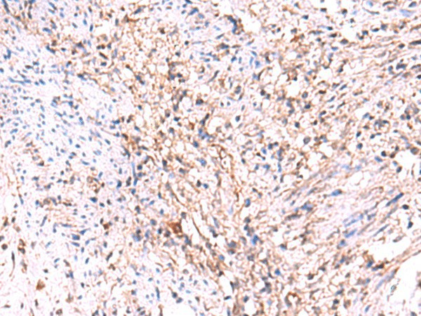 Immunohistochemistry of paraffin-embedded Human cervical cancer tissue  using MANSC1 Polyclonal Antibody at dilution of 1:105(?200)