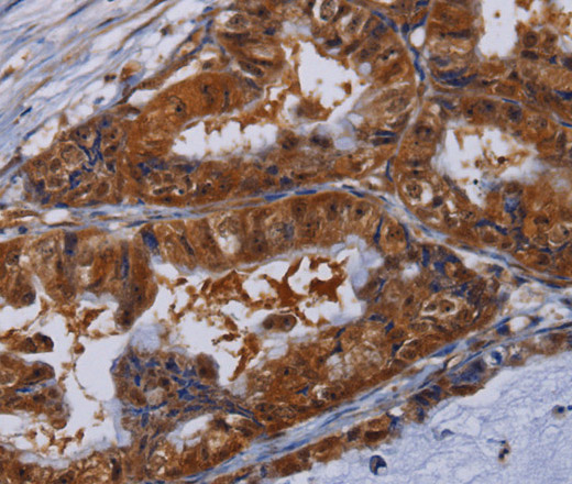 Immunohistochemistry of paraffin-embedded Human esophagus cancer tissue using MFAP3L Polyclonal Antibody at dilution 1:50