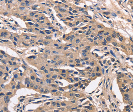 Immunohistochemistry of paraffin-embedded Human lung cancer using PEBP1 Polyclonal Antibody at dilution of 1:40