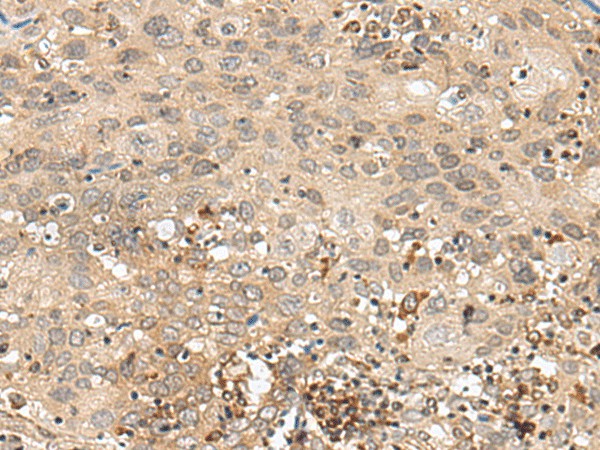 Immunohistochemistry of paraffin-embedded Human cervical cancer tissue  using GFI1 Polyclonal Antibody at dilution of 1:60(?200)