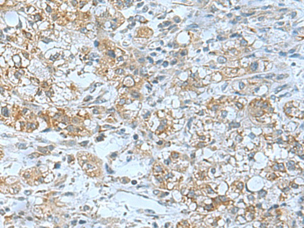 Immunohistochemistry of paraffin-embedded Human liver cancer tissue  using TSGA10 Polyclonal Antibody at dilution of 1:50(?200)