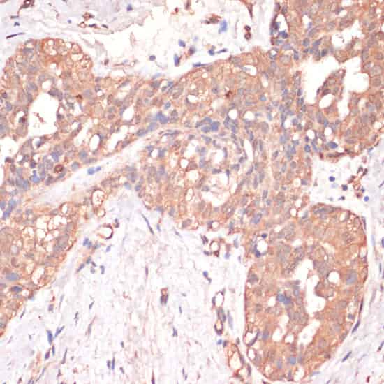 Immunohistochemistry of paraffin-embedded Human mammary cancer using Caspase-3 Polyclonal Antibody at dilution of 1:200 (40x lens).
