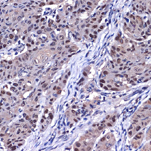 Immunohistochemistry of paraffin-embedded human esophageal cancer using [KO Validated] p53 Polyclonal Antibody at dilution of 1:100 (40x lens).Perform microwave antigen retrieval with 10 mM Tris/EDTA buffer pH 9.0 before commencing with IHC staining protocol.