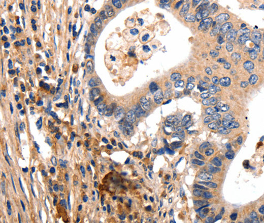 Immunohistochemistry of paraffin-embedded Human colon cancer tissue using GSK3 alpha Polyclonal Antibody at dilution 1:50