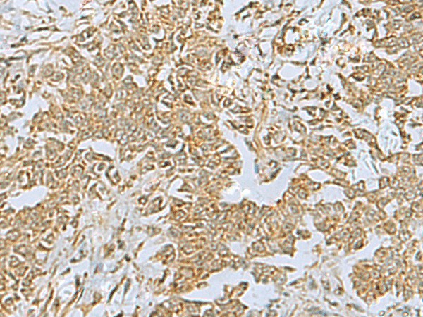 Immunohistochemistry of paraffin-embedded Human ovarian cancer tissue  using FAAP100 Polyclonal Antibody at dilution of 1:40(?200)