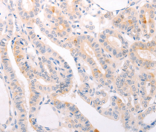 Immunohistochemistry of paraffin-embedded Human thyroid cancer using EDG3 Polyclonal Antibody at dilution of 1:30