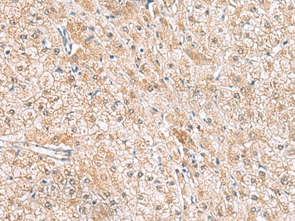 Immunohistochemistry of paraffin-embedded Human liver cancer tissue  using HLA-E Polyclonal Antibody at dilution of 1:50(?200)