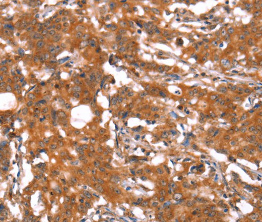 Immunohistochemistry of paraffin-embedded Human gastric cancer using FUT1 Polyclonal Antibody at dilution of 1:30