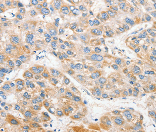 Immunohistochemistry of paraffin-embedded Human liver cancer tissue using ANAPC2 Polyclonal Antibody at dilution 1:30