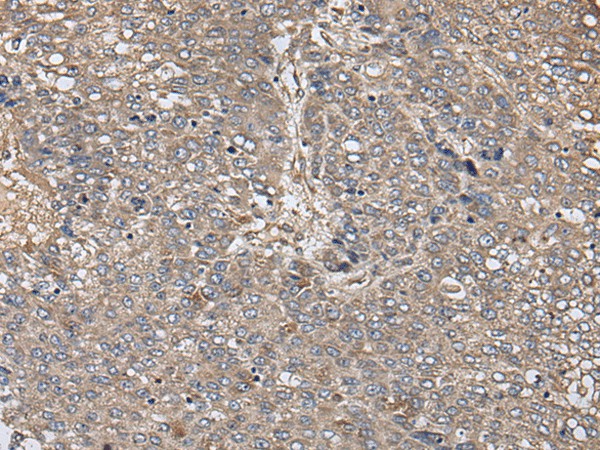 Immunohistochemistry of paraffin-embedded Human liver cancer tissue  using ZFP36 Polyclonal Antibody at dilution of 1:40(?200)