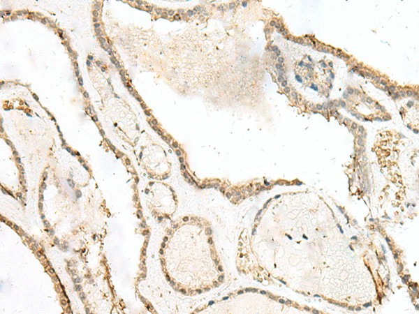 Immunohistochemistry of paraffin-embedded Human thyroid cancer tissue  using LIG4 Polyclonal Antibody at dilution of 1:40(?200)