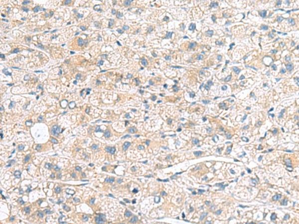 Immunohistochemistry of paraffin-embedded Human liver cancer tissue  using MYL1 Polyclonal Antibody at dilution of 1:75(?200)