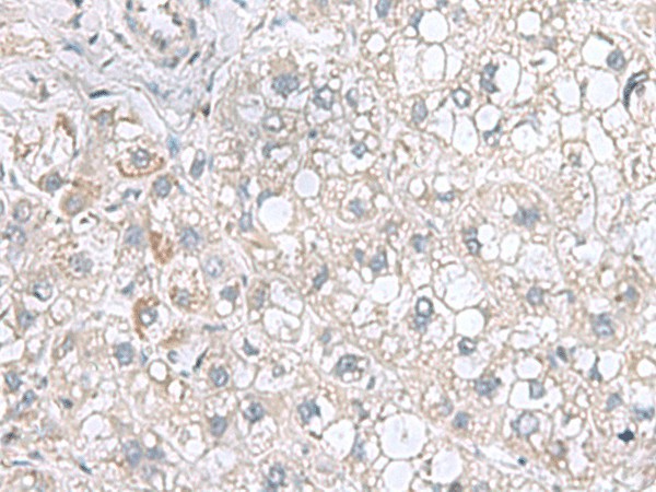 Immunohistochemistry of paraffin-embedded Human liver cancer tissue  using STK32A Polyclonal Antibody at dilution of 1:95(?200)