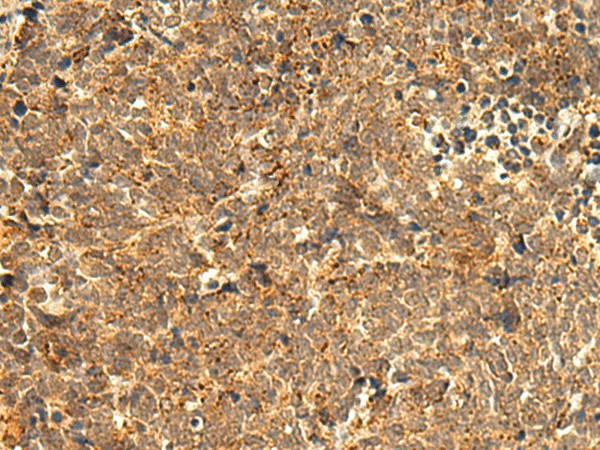 Immunohistochemistry of paraffin-embedded Human lung cancer tissue  using ABHD10 Polyclonal Antibody at dilution of 1:50(?200)