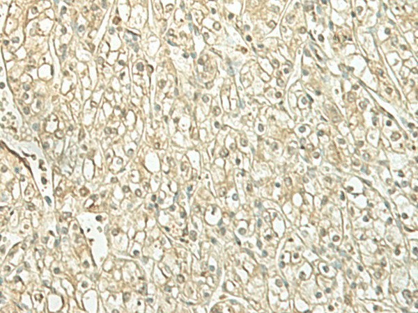 Immunohistochemistry of paraffin-embedded Human kidney cancer tissue  using SPIRE1 Polyclonal Antibody at dilution of 1:60(?200)