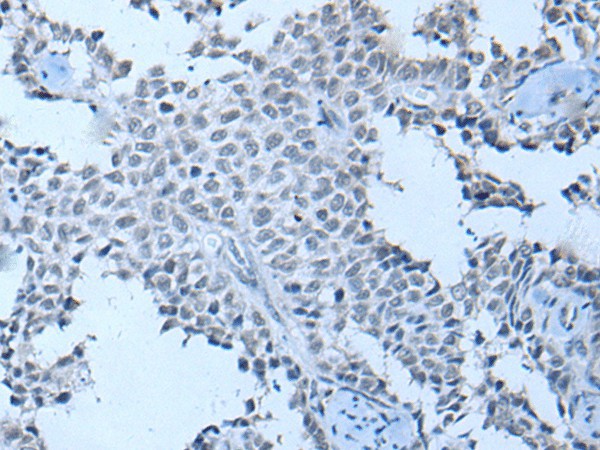 Immunohistochemistry of paraffin-embedded Human ovarian cancer tissue  using ZNF703 Polyclonal Antibody at dilution of 1:55(?200)